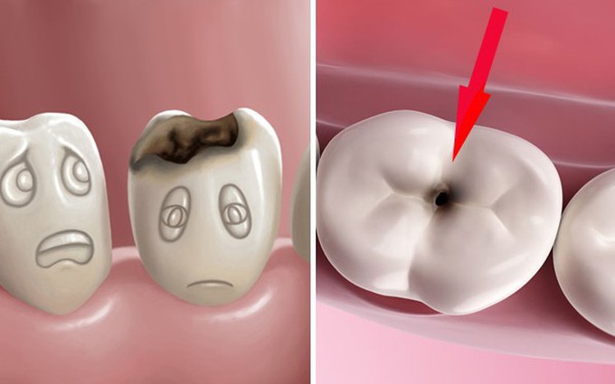 Bệnh sâu răng là gì: Những điều ít người biết