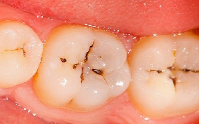 10 Dấu hiệu sâu răng dễ nhận biết và cách điều trị dứt điểm