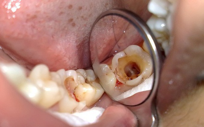 Nguyên nhân viêm tuỷ răng nhiều người không ngờ tới