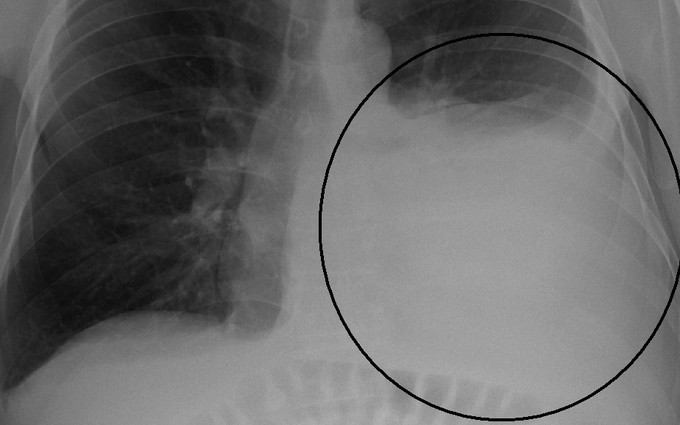 Bệnh phổi có nguy hiểm không và sự đáng sợ của căn bệnh viêm phổi do phế cầu khuẩn