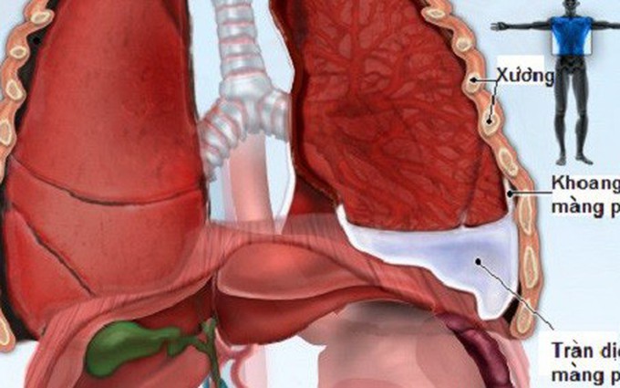 Bệnh về phổi thường gặp: Tìm hiểu về bệnh tràn dịch màng phổi