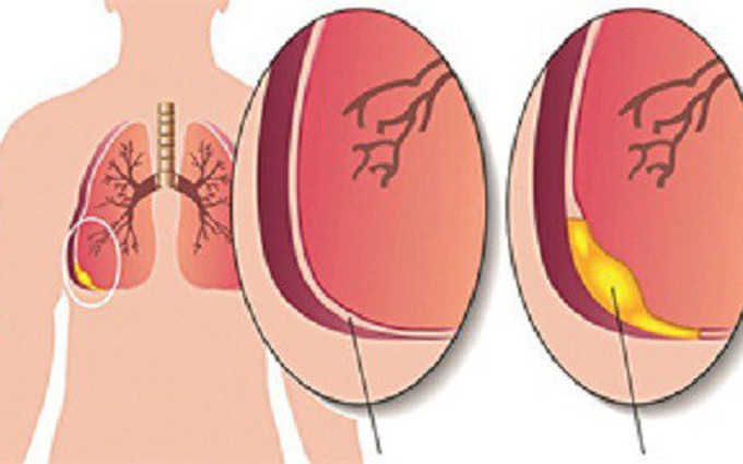 Các mức độ tràn dịch màng phổi từ thấp đến cao bạn cần nắm rõ