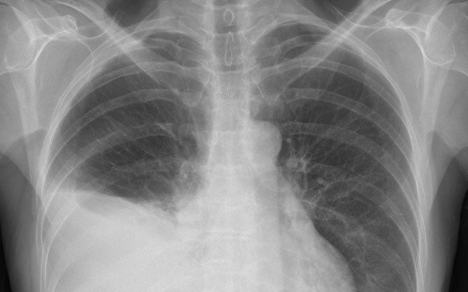 Cách siêu âm và chẩn đoán tràn dịch màng phổi