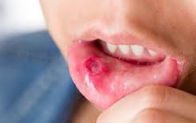 Triệu chứng bệnh lậu ở miệng, bạn nên đề phòng