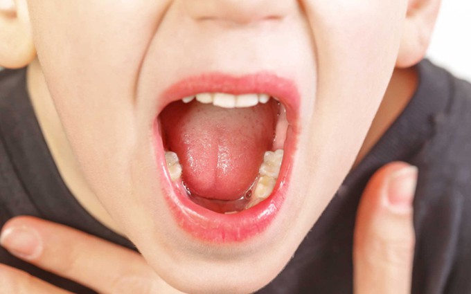 Viêm họng liên cầu khuẩn: Đừng chủ quan khi thấy những triệu chứng này