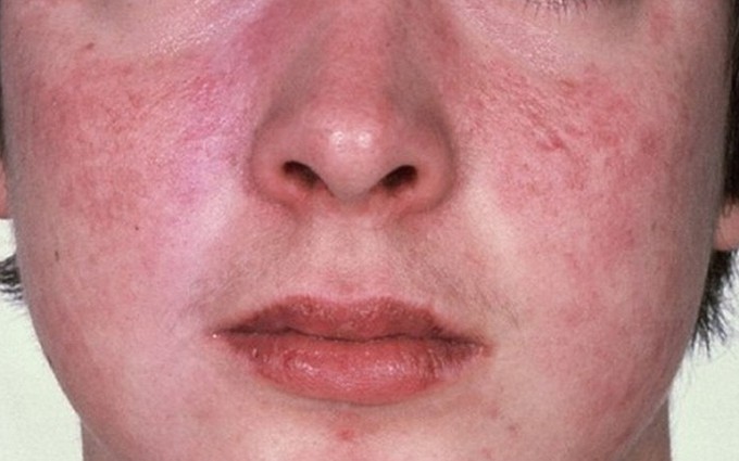 Các dấu hiệu bệnh lupus ban đỏ cảnh báo sức khỏe bạn đang gặp nguy hiểm