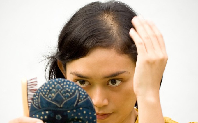 Những nguyên nhân gây ra hói đầu mà phái đẹp không thể ngờ tới