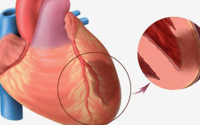 Dấu hiệu của bệnh u trong tim rất khó phát hiện