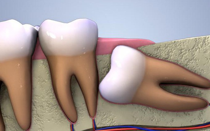 Răng khôn mọc kẹt - Cái nhìn chân thực từ chuyên gia