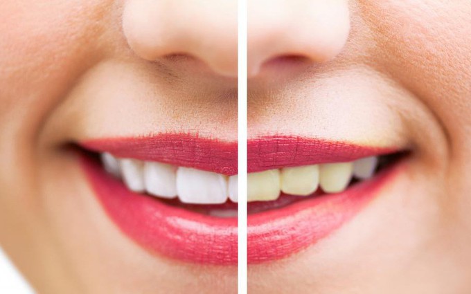 9 tuyệt chiêu giúp làm trắng răng hiệu quả