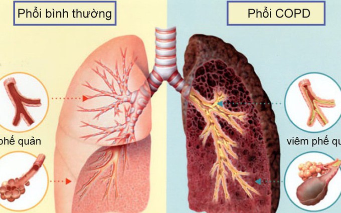 Bệnh phổi tắc nghẽn mãn tính là gì? Dấu hiệu, nguyên nhân, biến chứng và phương pháp điều trị