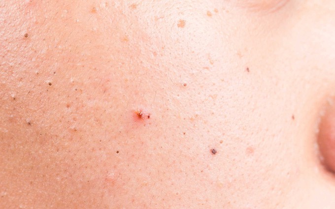 Da mặt có những dấu hiệu này, cẩn thận viêm lỗ chân lông, đi khám da liễu càng sớm càng tốt
