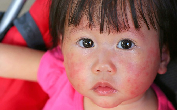 Dị ứng đậu phộng ở trẻ nhỏ: Nắm chính xác những triệu chứng này để cứu con kịp thời