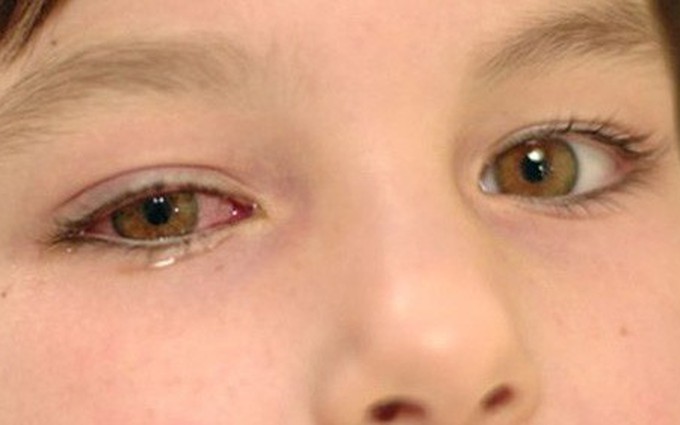 Biến chứng của bệnh thiên đầu thống có thể gây mù lòa