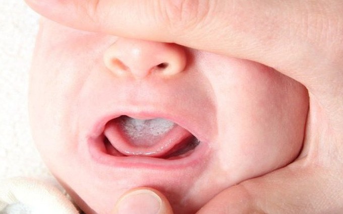 Nấm họng là gì và những điều cần biết về bệnh nấm họng