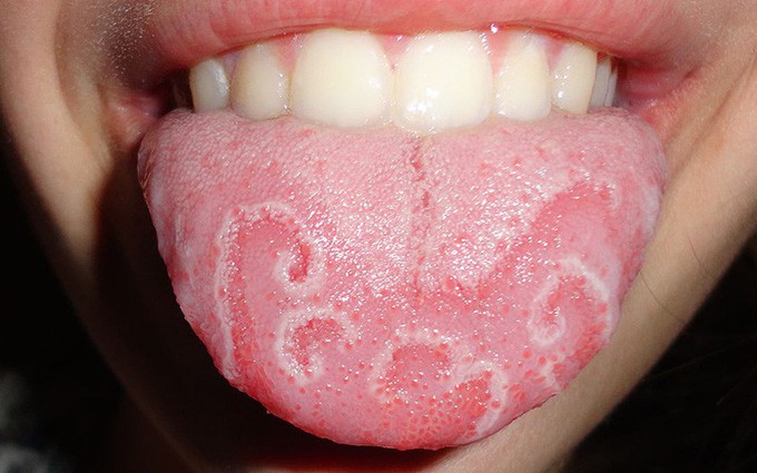 Bệnh về lưỡi