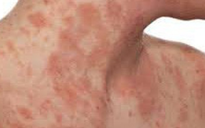 Bệnh chàm eczema là gì?
