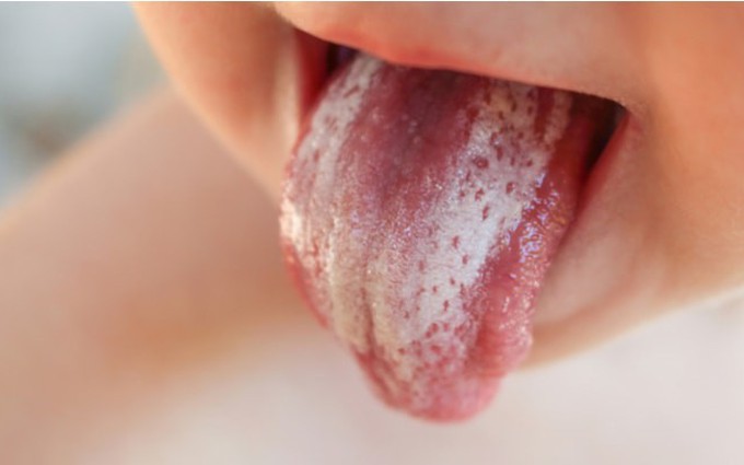 Tưa lưỡi là bệnh gì? Nguyên nhân và các triệu chứng trẻ bị tưa lưỡi