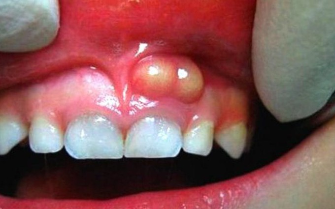  Áp xe răng: Mức độ nguy hiểm và cách điều trị
