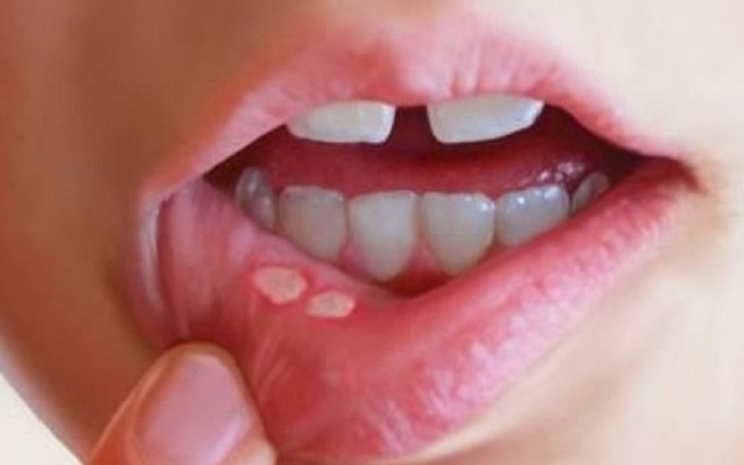 Nấm miệng là gì? Những điều cần biết về bệnh nấm miệng