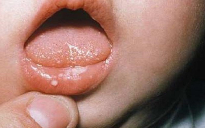 Nấm miệng trẻ sơ sinh: Nguyên nhân và cách điều trị
