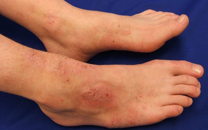 Viêm da cơ địa ở chân - Làm sao để biết mình mắc bệnh ?