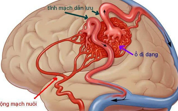 Bệnh dị dạng mạch máu não có thể gây đột tử không?