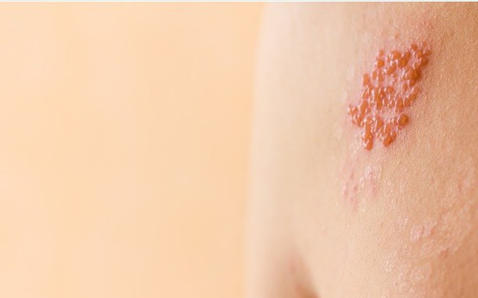 Bệnh viêm da tiếp xúc là gì? Nguyên nhân và cách phòng tránh căn bệnh ngoài da thường gặp