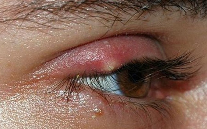 Cứ nghĩ mi mắt bị ngứa bình thường, ai ngờ đã mắc bệnh viêm bờ mi