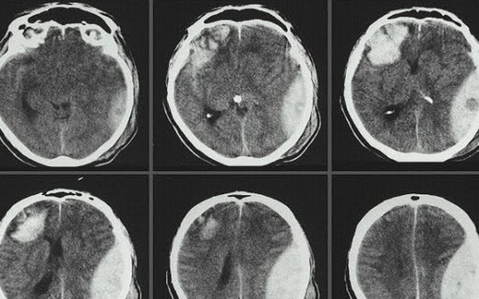 Tìm hiểu về bệnh chấn thương sọ não nhẹ