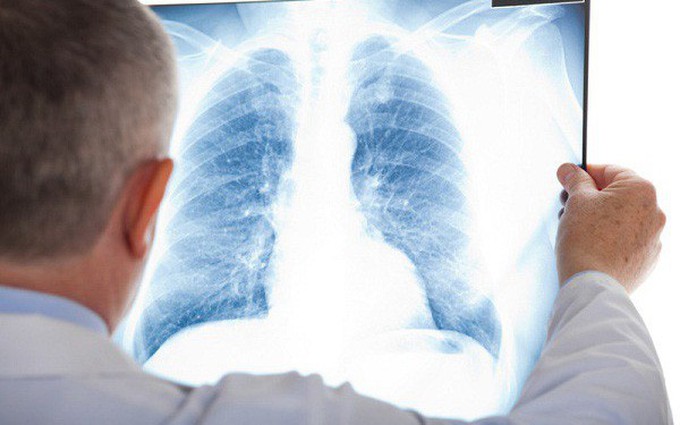 Tổng hợp những liệu pháp điều trị ung thư vú di căn phổi