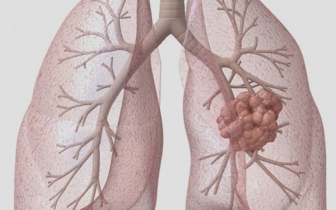 Ung thư vú di căn phổi là gì? Cơ chế lây lan, dấu hiệu nhận biết, điều trị và tiên lượng sống