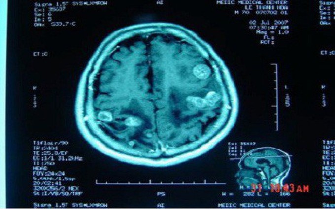 Phương pháp mới điều trị ung thư vú di căn não