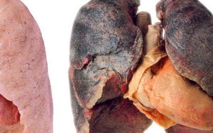 Bệnh ung thư phổi tế bào nhỏ: nỗi ám ảnh với tỷ lệ sống không quá 9 tháng!