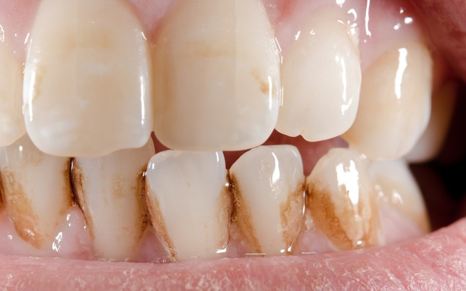 9 nguyên nhân khiến răng bị ố vàng, xỉn màu