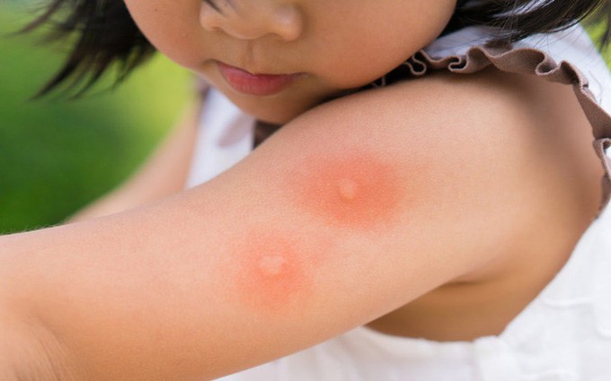 4 biện pháp phòng sốt xuất huyết lây lan trong gia đình khi có một người trong nhà mắc bệnh