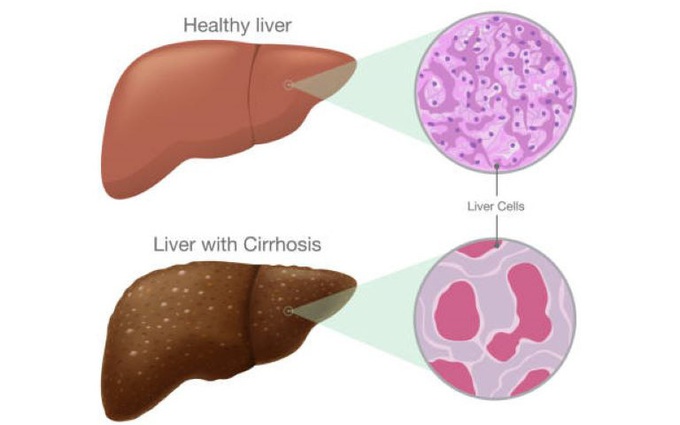 Phương pháp giúp làm chậm xơ gan tiến triển