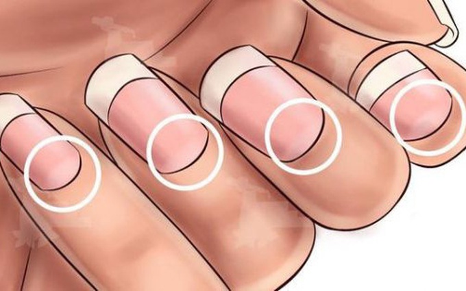 Nhận biết bệnh qua màu sắc móng tay: Nếu móng tay có biểu hiện này, khám ung thư ngay