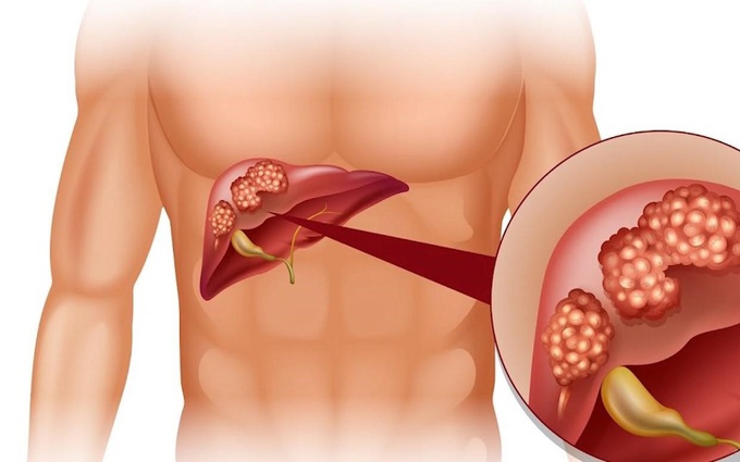 Phân biệt viêm gan mạn tính và xơ gan: cảnh báo nguy hại sức khỏe gan
