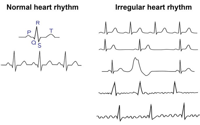 Rối loạn nhịp tim là gì? 10 điều cần nhớ về chứng rối loạn nhịp tim