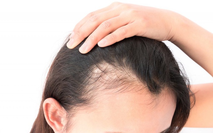 Tóc bạn đang thưa dần hay cứng hơn? Cẩn thận với nguy cơ mắc các bệnh sau!