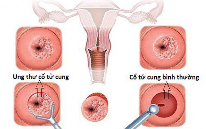 Ung thư cổ tử cung: Nguyên nhân, dấu hiệu và cách phòng tránh