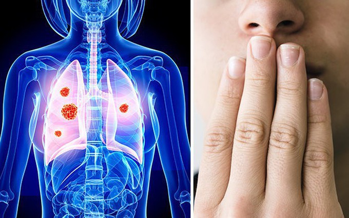 Ung thư phổi có nguy hiểm không?