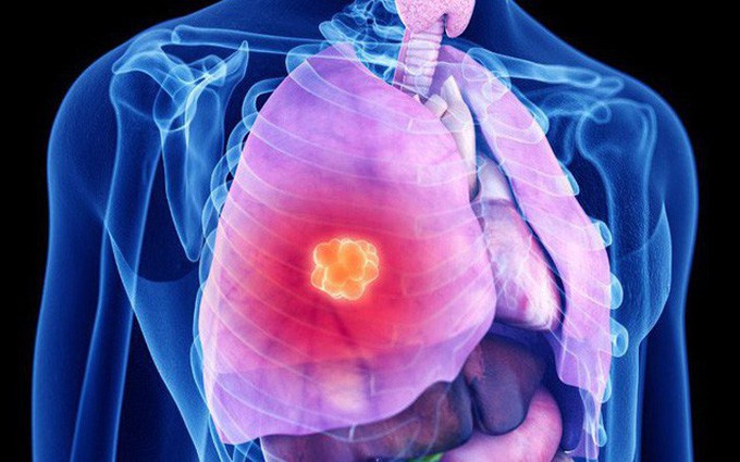 8 dấu hiệu viêm phổi cần nhận biết sớm để ngừa biến chứng nguy hiểm