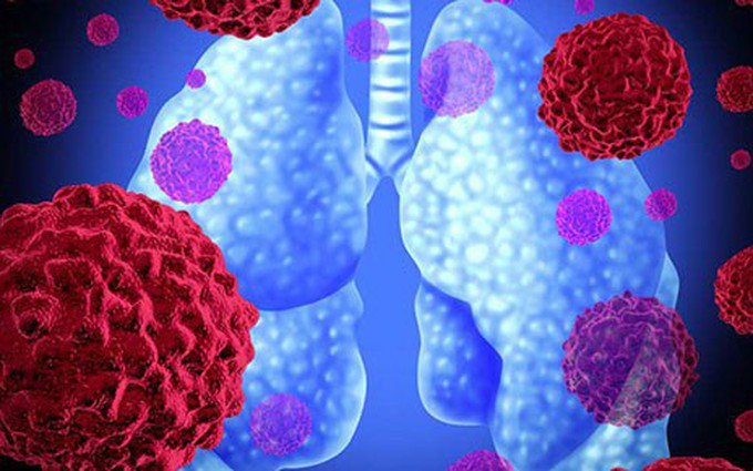 Tổng hợp các dấu hiệu của bệnh viêm phổi do virus