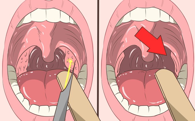 Biến chứng nguy hiểm từ bệnh viêm họng hạt mãn tính