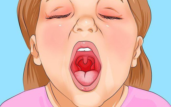 Bệnh viêm họng trắng có nguy hiểm không và cách điều trị an toàn