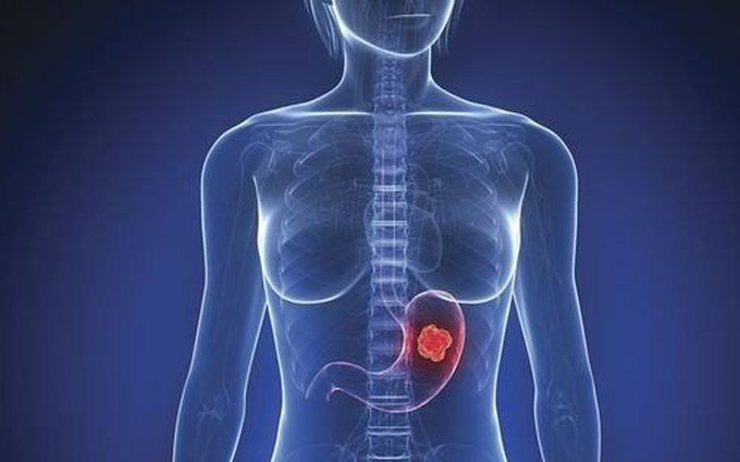 Phân biệt polyp dạ dày lành tính và polyp có nguy cơ thành khối u dạ dày ác tính (ung thư dạ dày)