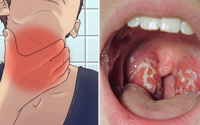 Nổi hạch ở sau hàm có thể là dấu hiệu bệnh viêm họng giả mạc