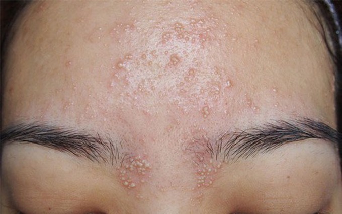 Viêm nang lông ở mặt: Triệu chứng, nguyên nhân, phòng ngừa và cách chữa trị